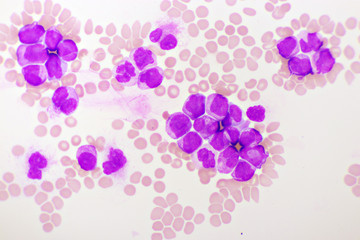 Acute promyelocytic leukemia cells or APL, analyze by microscope, original magnification 1000x