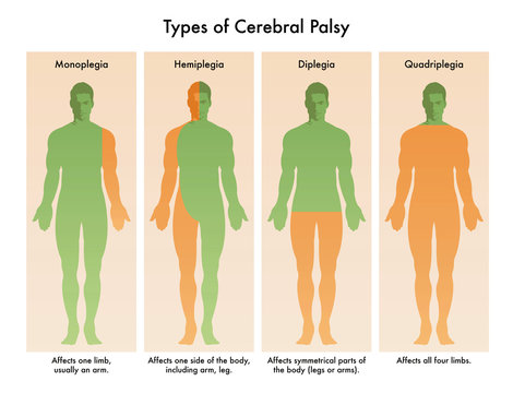 Forms of Cerebral Palsy illustrated in medical diagram.