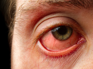 conjunctivitis, conjunctival inflammation, red eyes, infection and inflammation, close up eye - obrazy, fototapety, plakaty