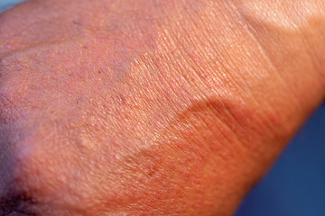 Close up of skin with sunburn.