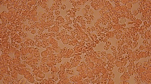 Blood under a microscope, the movement of spur-shaped red blood cells, which indicates a human disease, in most cases are formed due to smear artifact 4K
