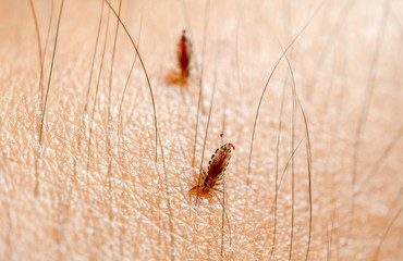 Louse, Head lice feed on blood on human skin.