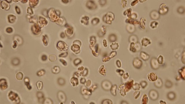 Blood under a microscope, the movement of dead and damaged cells in human blood that have lost their shape and color 4K