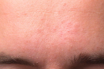 weeping eczema in the stage of exudation. Closeup of forehead area with eczema rash clinic