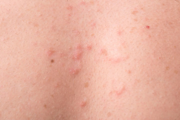 Fototapeta premium streptococcal skin infection, in the form of rash elements. Folliculitis of the skin of the back.