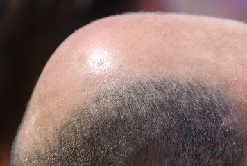 Male pattern baldness. Increased testosterone disease
