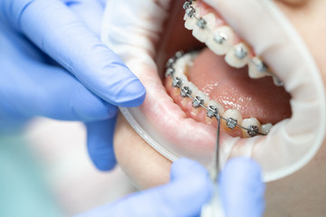 Close-up of teeth with braces. Dentistry and the procedure for adjusting iron braces on the teeth in the patient's mouth. - obrazy, fototapety, plakaty