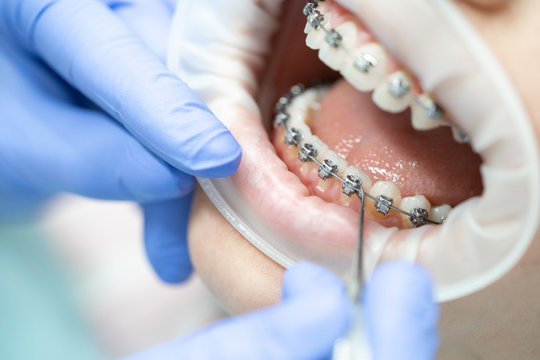 Close-up of teeth with braces. Dentistry and the procedure for adjusting iron braces on the teeth in the patient's mouth.