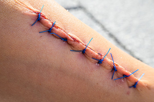 Wound with suture after surgery