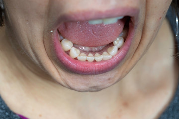 Woman with open mouth showing teeth