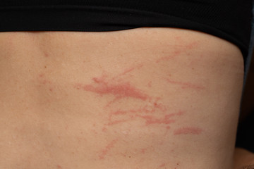 Close up view of body with scratches on skin, allergic reaction