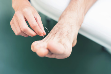 Man on acupuncture