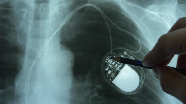 Doctor Examining X-Ray Image of Chest with Artificial Cardiac Pacemaker Implant