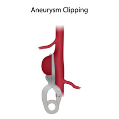 Aneurysm repair with clipping. Medical anatomy illustration.