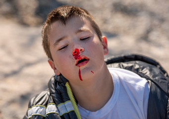 Boy ten years old with his nose bleeding