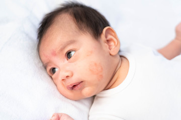 Close up face of newborn baby with eczema on the cheek, concept of healthcare and skin problem in the newborn baby.