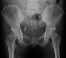 X-ray image of bladder, Showing bladder stone