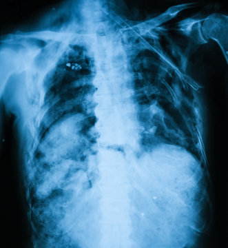 Chest x-ray image of a dead man, car accident