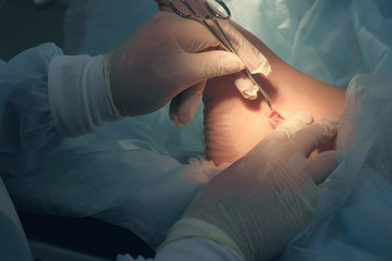 Surgeon making surgery of removal ankle hygroma in hospital in operating room, hands closeup. Doctor examines incision area, pushing skin by clip. Operation surgical treatment of hygroma on leg.