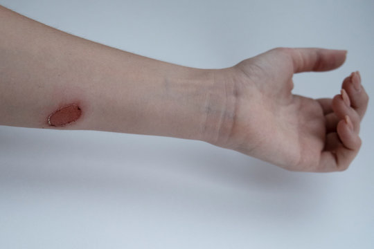 Second degree burn of a woman's hand on white background
