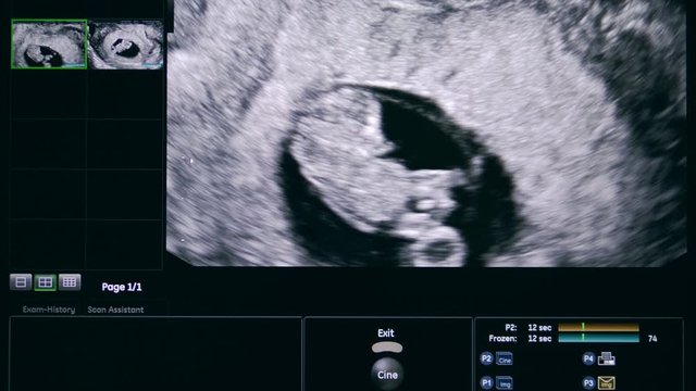 Unborn baby on the ultrasonic image