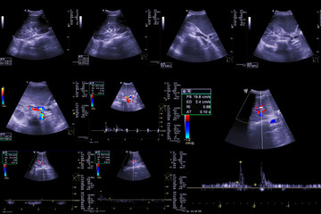  Collection  of Ultrasound upper abdomen showing anatomical of  hepatobiliary system and Liver and...