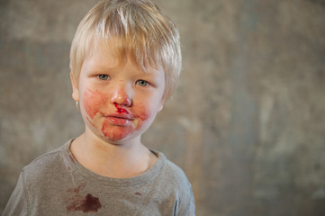 little fair-haired boy is smeared with blood. baby has weak vessels in nose bursting with pressure drops and changes in weather. Hemophilia disease. Blond child lifts his head to stop the bleeding