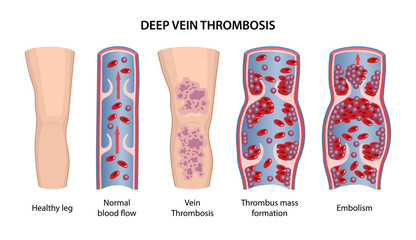 Deep vein thrombosis. Image of healthy and diseased legs. A longitudinal section of a veins with a description of the main stages. Vector illustration in flat style isolated on white background