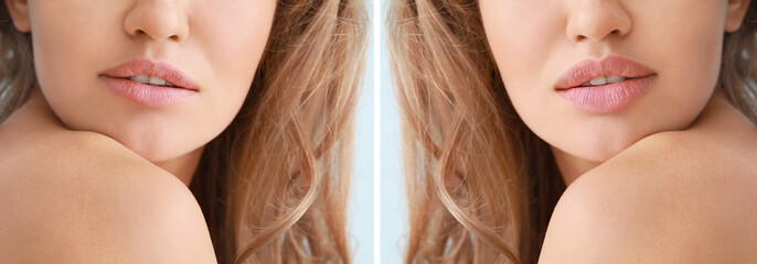 Young woman before and after lip enhancement