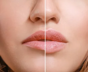 Fotobehang Young woman before and after lip enhancement, closeup © Pixel-Shot