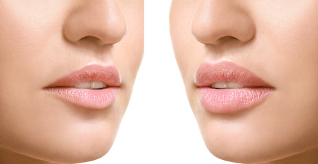 Young woman before and after lip enhancement on white background, closeup
