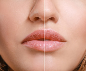 Young woman before and after lip enhancement, closeup