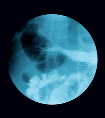 X-ray image of barium meal examination of stomach and duodenum, case of gastroenteritis andcolitis