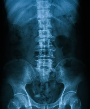 X-ray image of lumbosacral spine, anteroposterior (AP) view, show ankylosing spondylitis lumbar