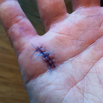 Stitches (sutures) in palm of a male human hand after Trigger Finger (Stenosing tenosynovitis) surgery