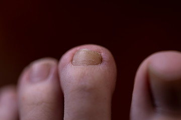 Chiropody diagnosis macro close up of a foot with mycosis on one of the nails of a toe which is disfigured and has a yellow brown coloration, also known as chalk nail, against a dark background