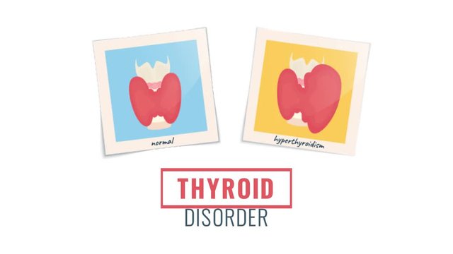 Cartoon animation of photo frames of hyperthyroid and healthy glands.  Growing goiter vs normal thyroid in front view. Human body organ anatomy. Medical concept. Seamless looped motion graphics. 