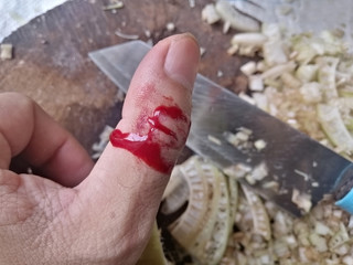 Injured thumb with bleeding open cut. Fresh wound on the thumb finger. 