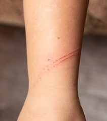 child's hand scratch