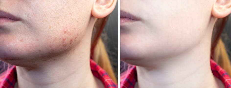 Как выглядит демодекоз на лице у женщин Rosacea Before And After Images - Browse 167 Stock Photos, Vectors, and Video Ad