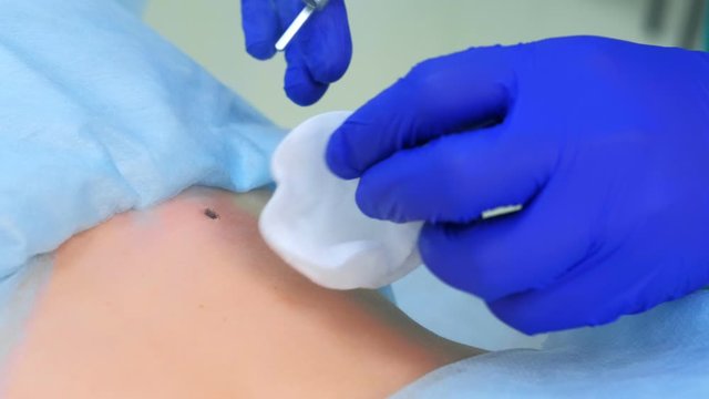 Process removing mole using laser on patient back by surgeon, closeup view after procedure. One day surgery concept. Removed birthmark or nevus on skin. Cosmetic treatment. Wound after operation.