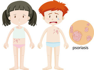 Boy and girl with psoriasis