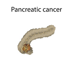 Pancreatic cancer. Pancreas, tumor. Medical anatomy illustration.