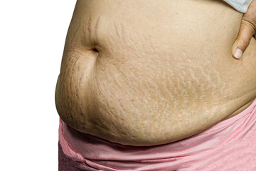 Belly Pattern fat stomach woman. Abdominal scar marked pattern. Pregnant women with striped belly