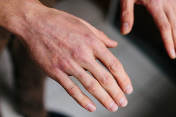 Psoriasis skin. Closeup of rash and scaling on the patient's skin. The concept of chronic disease...