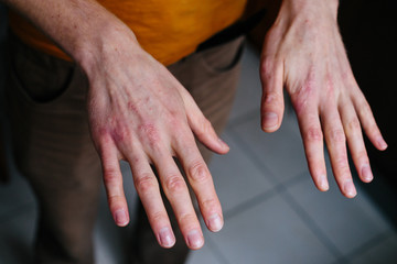 high angle view of hands suffering the dryness on the skin and deep cracks on knuckles. Eczema or psoriasis on hands
