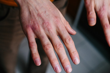 high angle view of hands suffering the dryness on the skin and deep cracks on knuckles. Eczema or psoriasis on hands