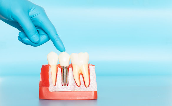 Plastic samples of dental implants compare with natural teeth.