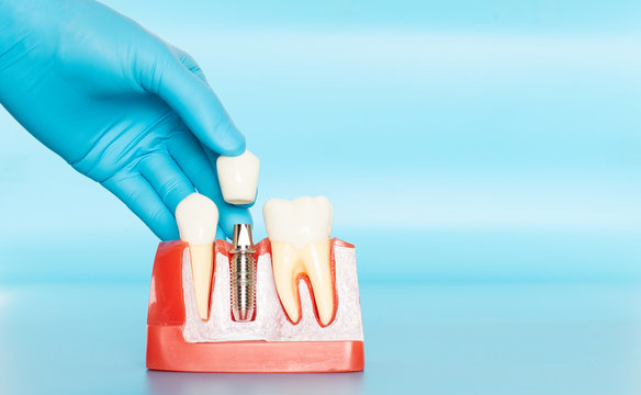 Plastic samples of dental implants compare with natural teeth.