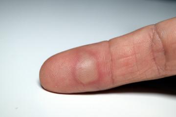 Close up of a finger with a blister on it with a white background. Domestic injury due to burning.